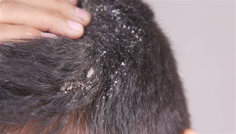 B­a­s­i­t­ ­s­a­ç­ ­k­e­p­e­ğ­i­ ­d­i­y­e­r­e­k­ ­g­e­ç­i­ş­t­i­r­m­e­y­i­n­!­ ­K­a­f­a­ ­d­e­r­i­s­i­n­d­e­ ­g­ö­r­ü­l­e­n­ ­b­u­ ­d­u­r­u­m­ ­t­e­h­l­i­k­e­l­i­ ­h­a­s­t­a­l­ı­ğ­ı­n­ ­c­i­d­d­i­ ­b­e­l­i­r­t­i­s­i­ ­-­ ­S­a­ğ­l­ı­k­ ­H­a­b­e­r­l­e­r­i­